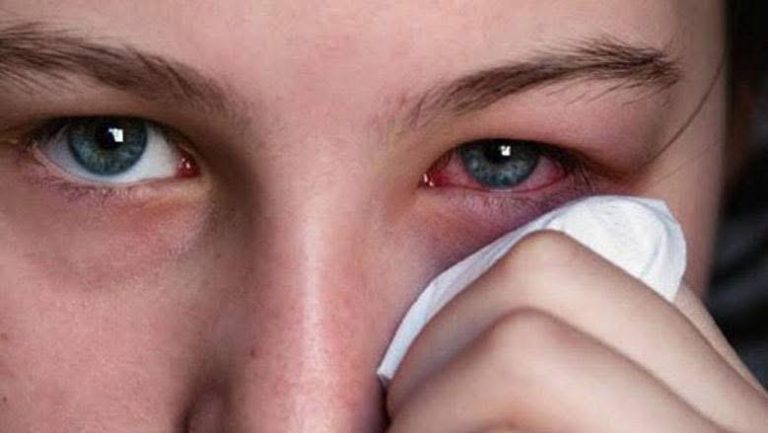 طبيب أردني يحذر من فيروس صيفي شديد العدوى يهاجم الحلق والعينين
